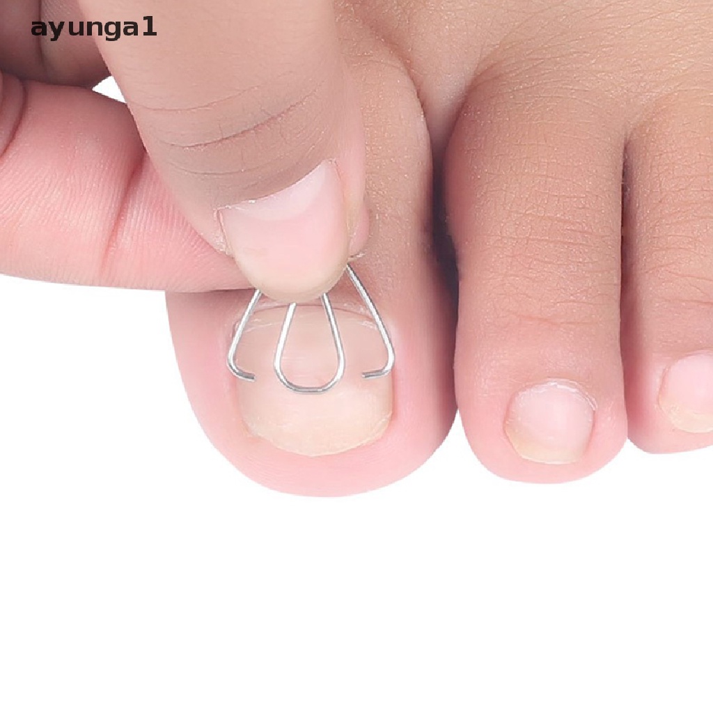 [ayunga1] Nail Art Ingrown Toe Nail Correction Tool Toenail Nail Orthosis Paronychia Clip [new]