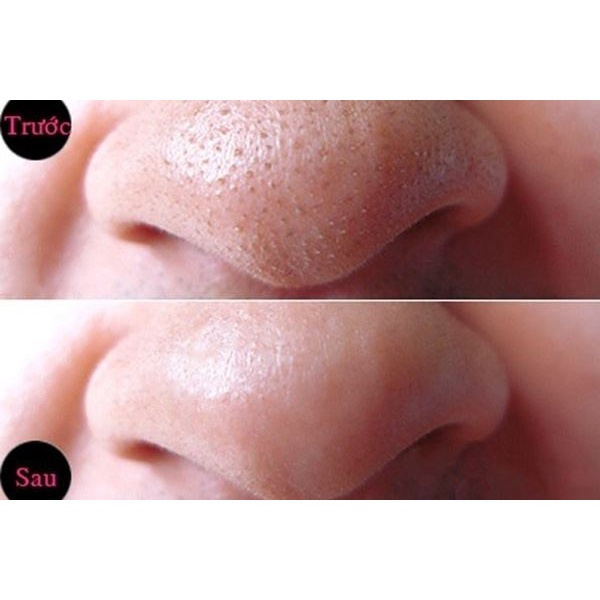 Gel lột mụn TiTione (15g)