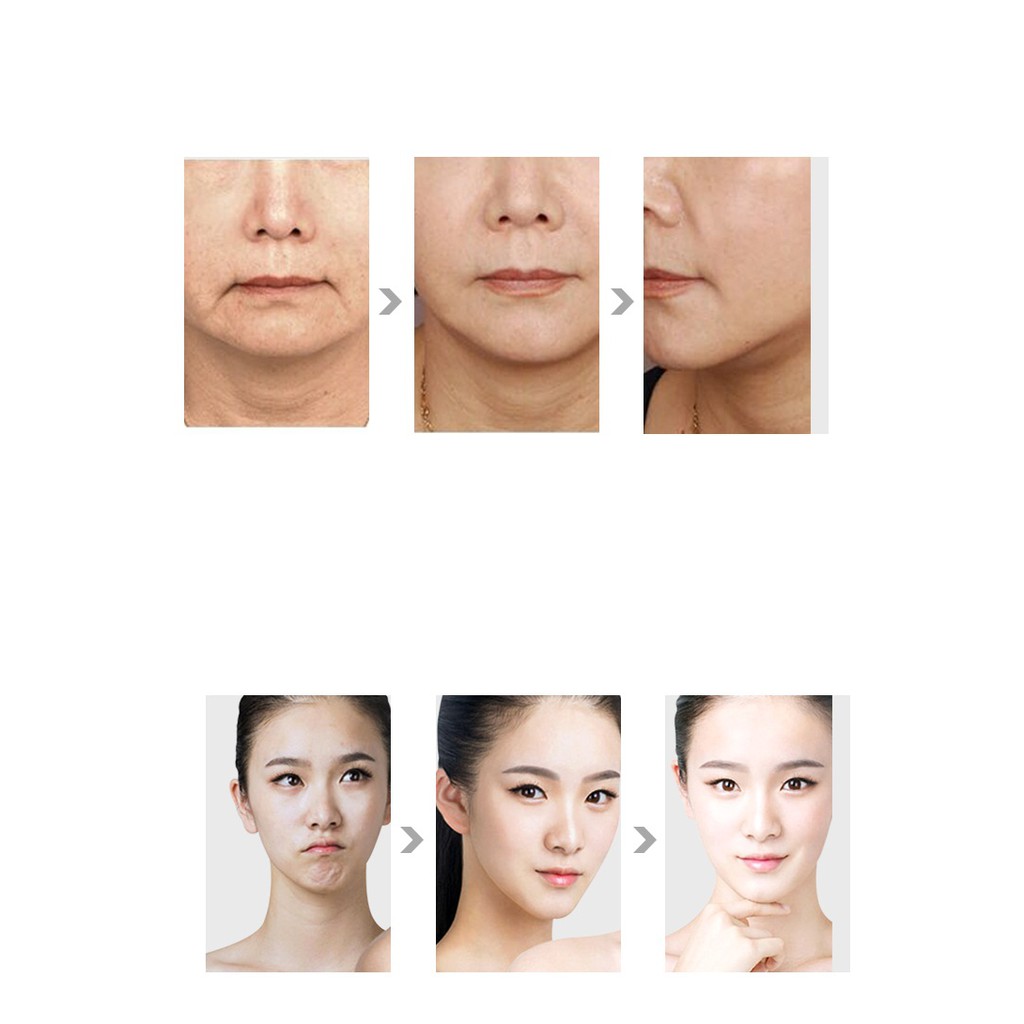 Máy nâng cơ trẻ hóa da xóa nhăn tạo mặt Vline HIFU Vmax