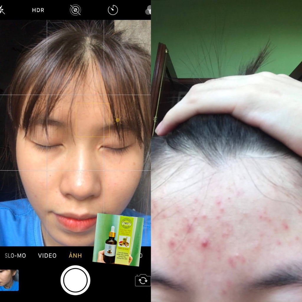 Thảo Dược Giảm Mụn Thâm Rỗ MT | BigBuy360 - bigbuy360.vn