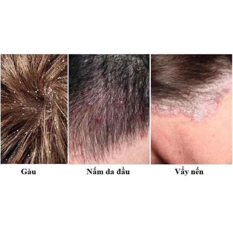 [CHỈ BÁN HÀNG THÁI] DẦU GỘI NẤM DA ĐẦU,GÀU THÁI LAN[SẴN][FREESHIP][CHUẨN HÀNG][BẢO HÀNH 7 NGÀY] | BigBuy360 - bigbuy360.vn
