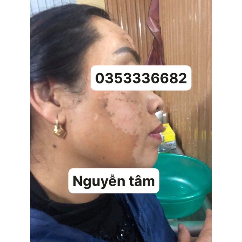 NANO PEEL PLUS ( siêu vi kim tinh thể kim cương nano peel plus) mua 1 tăng 1 kem chống nắng gogreen