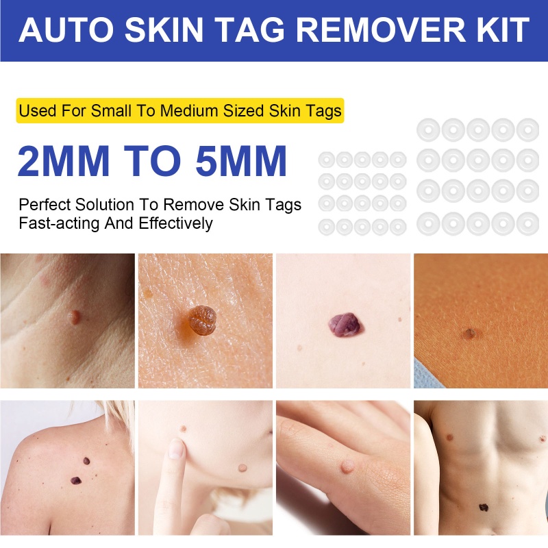 Youyo Bộ Dụng Cụ Loại Bỏ Mụn Cóc An Toàn Nhanh Chóng Trong Phút Và Khăn Lau