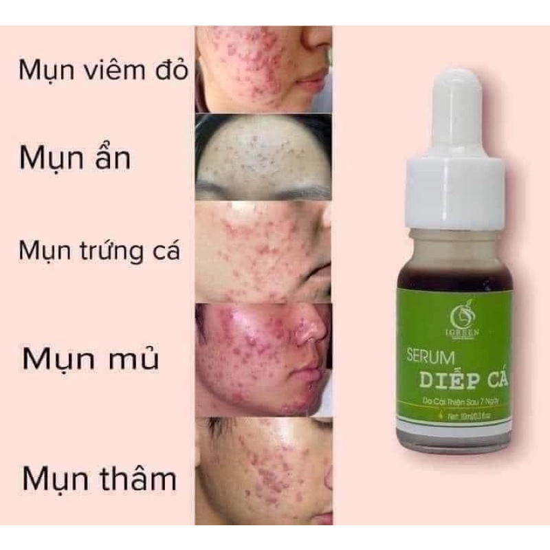 Serum giảm mụn, giảm thâm_không gây bong tróc_dị ứng mẩn ngứa, dành cho mọi loại da_da dầu mẹ bầu tặng quà