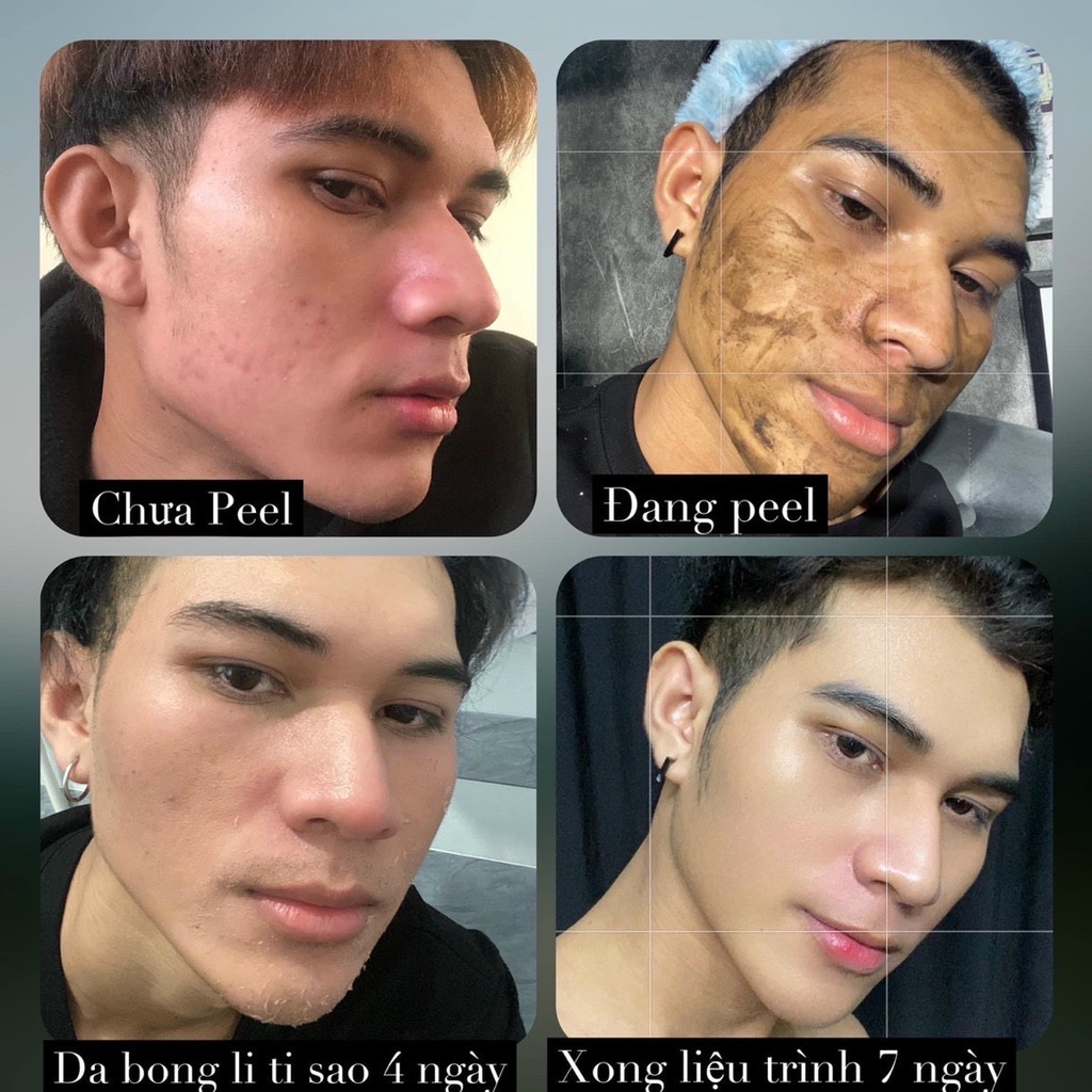 LE’PEAU - Peel da Vi Tảo Retinol của công ty Việt Nam