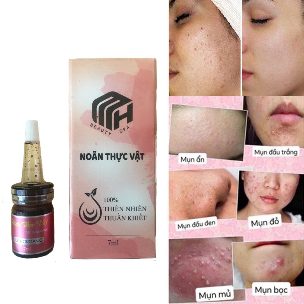 COMBO 2 Hộp Noãn Thực Vật mh Thần Dược Mh beauty spa Sạch Mụn Mờ Thâm Hiệu Quả Sau 3 Ngày