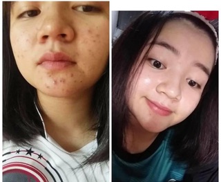 Kem Mụn thái lan 5 món