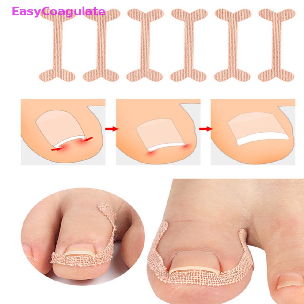 Eas Miếng Dán Cải Thiện Tình Trạng Đau Ngón Chân Và Làm Cong Móng