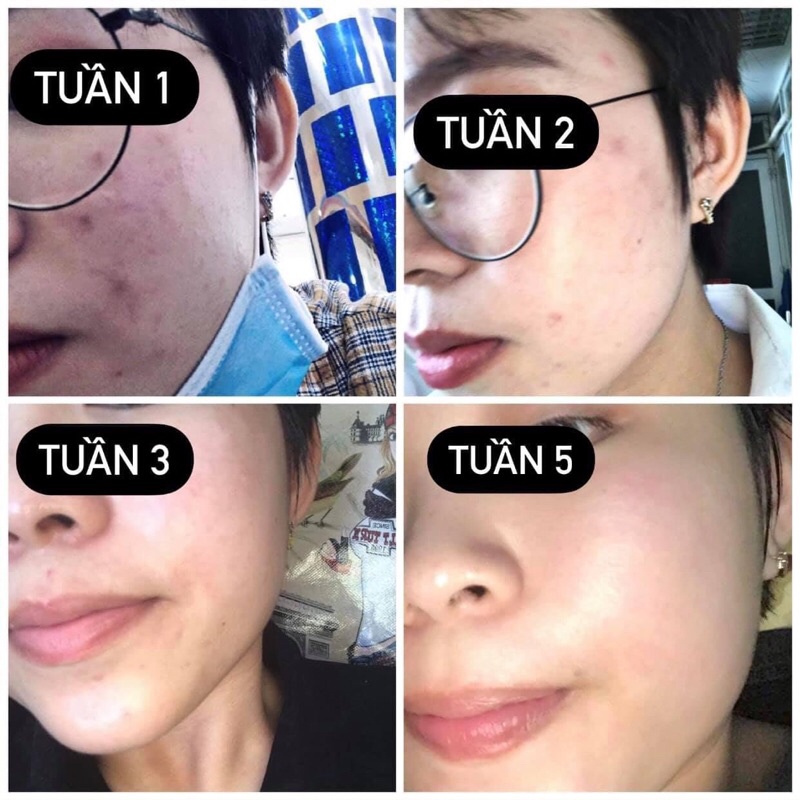 Gel bôi mụn cùng công thức với Differin Adapalene 0.1% dành cho da mụn ẩn mụn mủ viêm mụn đầu đen và da sần sùi | BigBuy360 - bigbuy360.vn