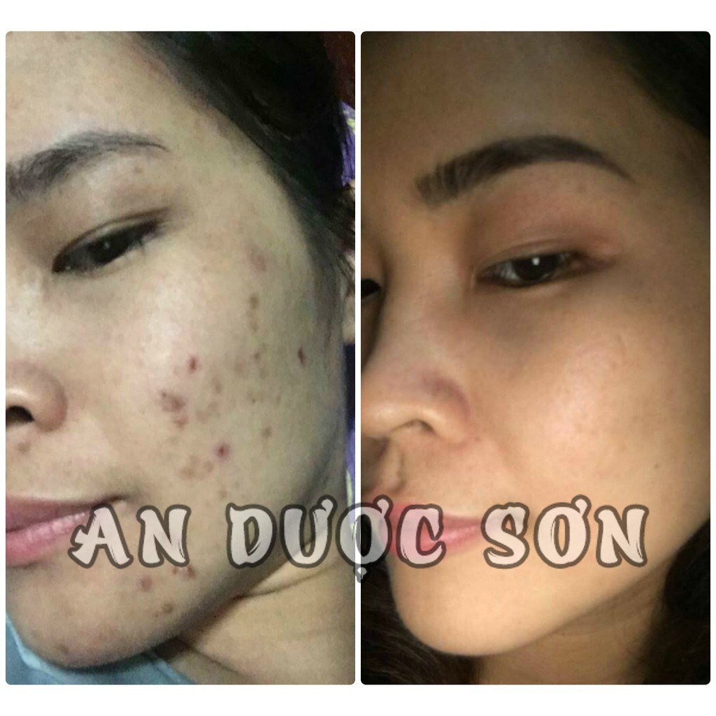 Serum Hết Mụn Tận Gốc An Dược Sơn - Tái Tạo Da Sạch Thâm Nám, Tàn Nhang, Sẹo Rỗ - Chai 30ml