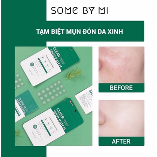 Miếng dán mụn Some By Mi Don't Pop It. Just Leave It 18 miếng