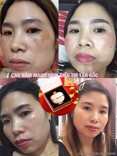CAO NÁM MAGIC SKIN