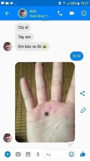 Gel tẩy mụn ruồi, mụn cóc, mụn thịt, mụn cơm