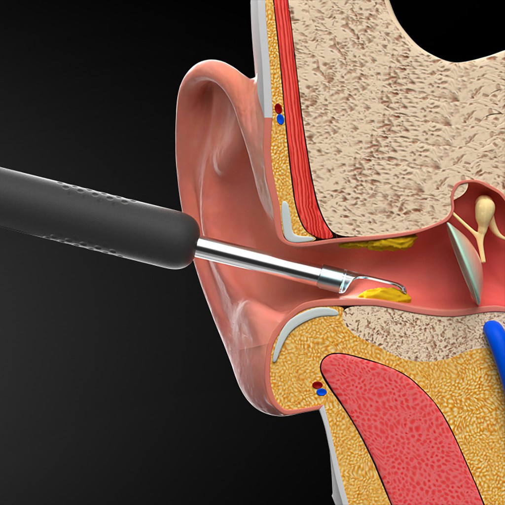 Dụng cụ lấy ráy tai Xiaomi Bebird R1 - Lấy ráy tai có camera giảm nguy cơ thủng màng nhĩ, vệ sinh sạch lỗ tai