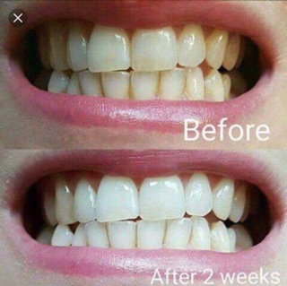 KEM ĐÁNH RĂNG TRẮNG RĂNG AP24
