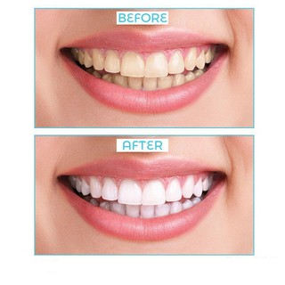 Máy đánh bóng răng, làm trắng Luma Smile