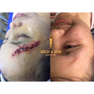 CAO SẸO ( FREE SHIP ) BÁCH Y SÂM - BẠCH LINH