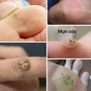 Tẩy nốt ruồi mụn cóc Nga