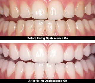 Kem đánh răng OPALESCENCE WHITENING TOOTHPASTE