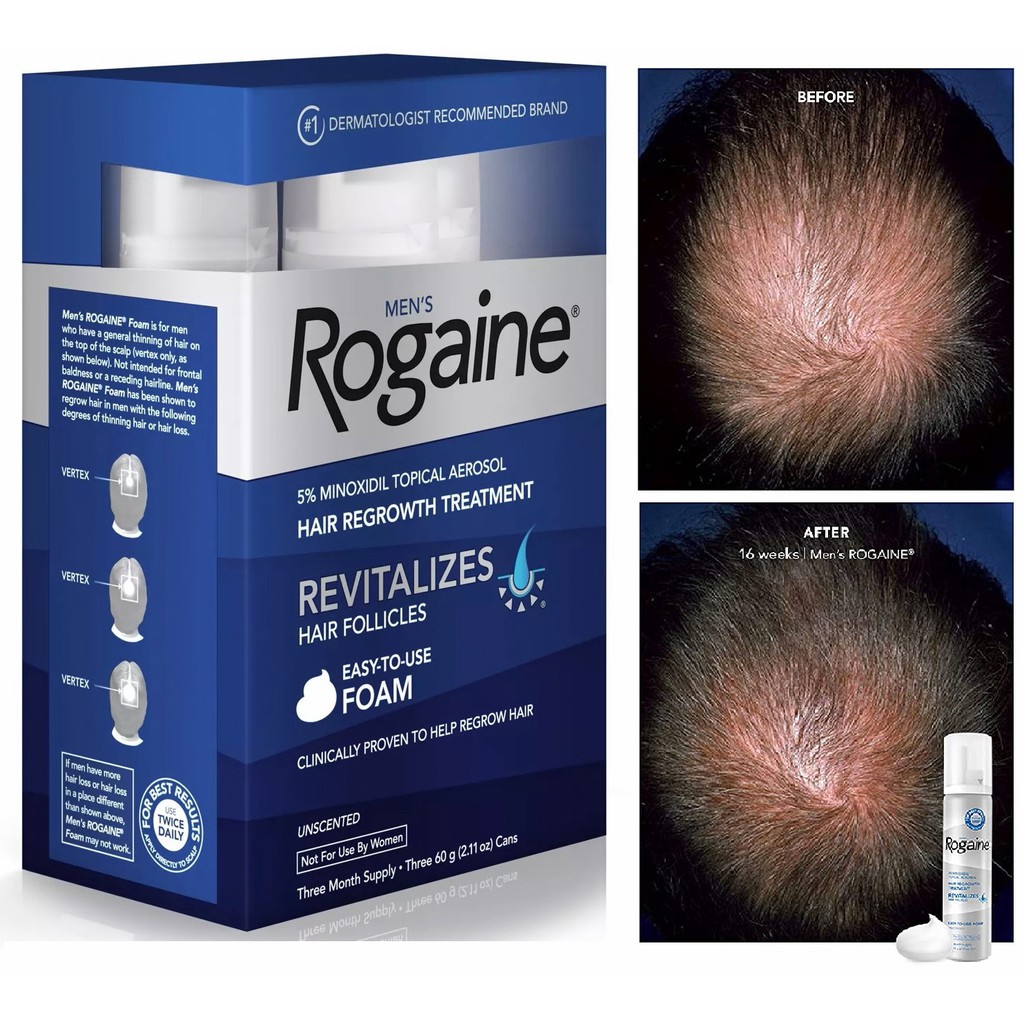 Kem mọc tóc Rogaine Minoxidil 5% Foam cho Nam (bộ 3 chai 60ml *3)