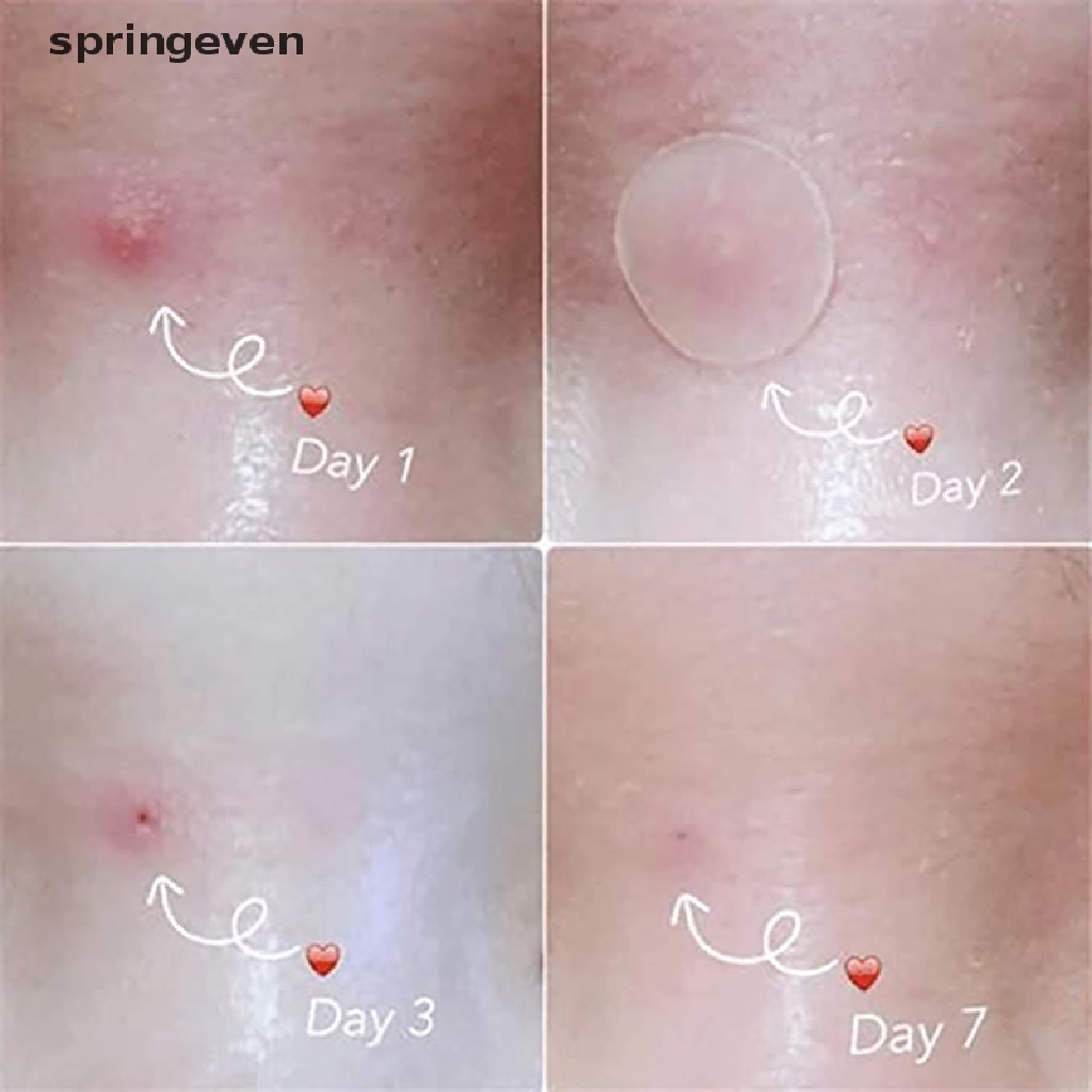 Bộ 36 Miếng Dán Mụn Hydrocolloid Và Mụn Thịt springeven  Máy Hút Bụi Cầm Tay