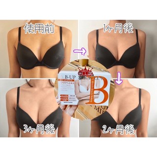 NỞ NGỰC B UP MIRACLE
