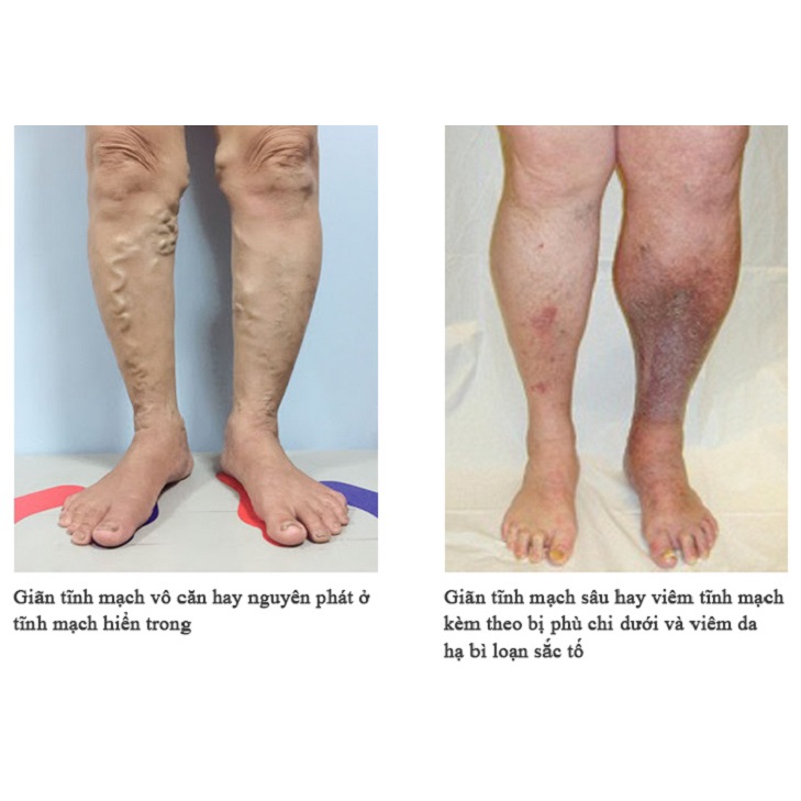 Kem chống giãn tĩnh mạch, tinh chất thảo dược thiên nhiên 100%, chống suy giãn, giảm đau, ngứa