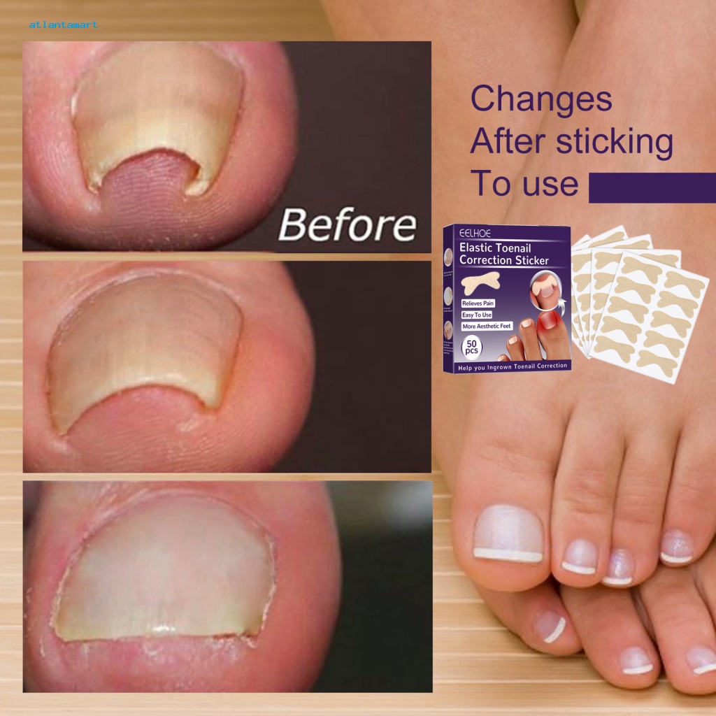 Atl| Miếng Dán Chỉnh Hình Móng Chân Mọc Ngược Tiện Dụng