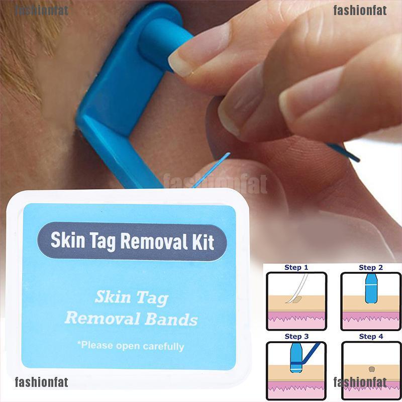 [Iron] 30Pcs Skin Tag Removal Rubber Bands Micro Band Non Toxic Face Care Mole Wart