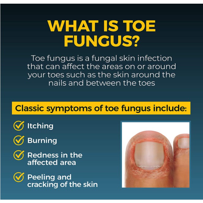 Fungi Nail Mỡ Bôi Chống Nấm Móng Tay và Chân 20g