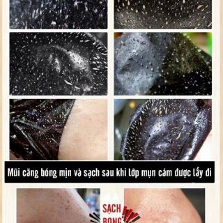 Gel lột mụn