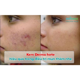 [CHÍNH HÃNG] Giảm Thâm mụn DERMA FORTE