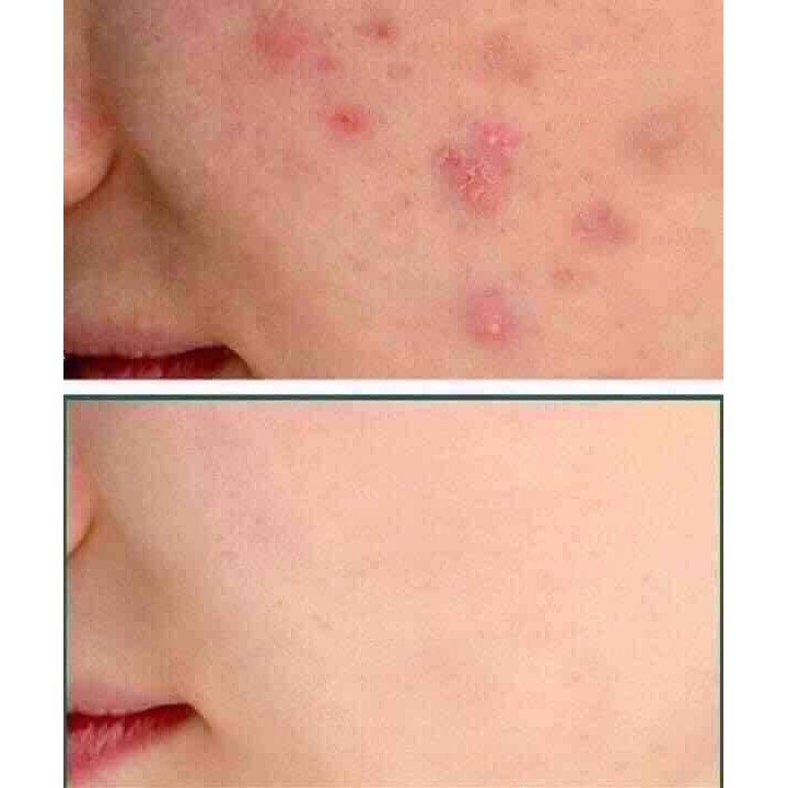 kem tri mụn kracie nhật bản | BigBuy360 - bigbuy360.vn