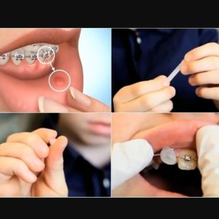 Sáp nha khoa Forestaden (Đức) giảm đau môi má do mắc cài