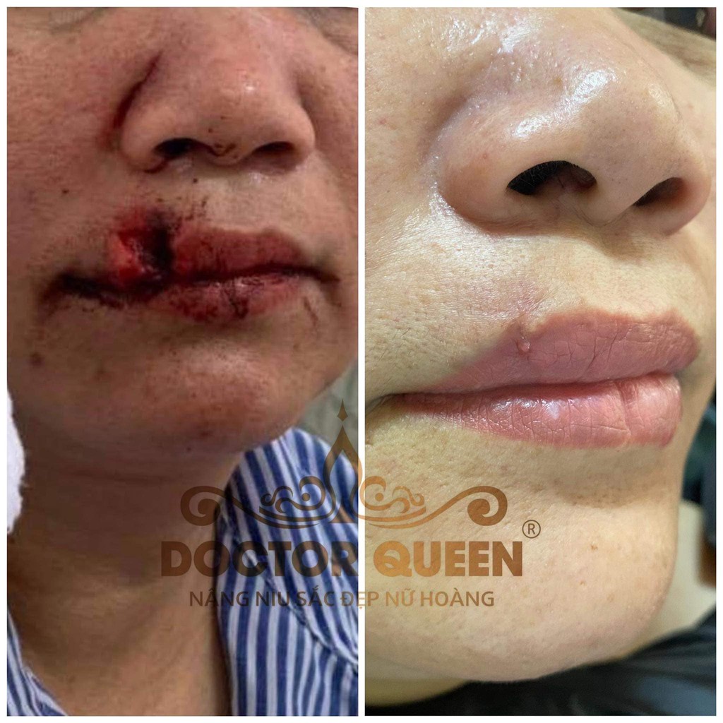 CAO NGHỆ DOCTORQUEEN (ngừa thâm nám,mụn,bỏng,sẹo,ngã xe các vết thương,...làm sáng da,)