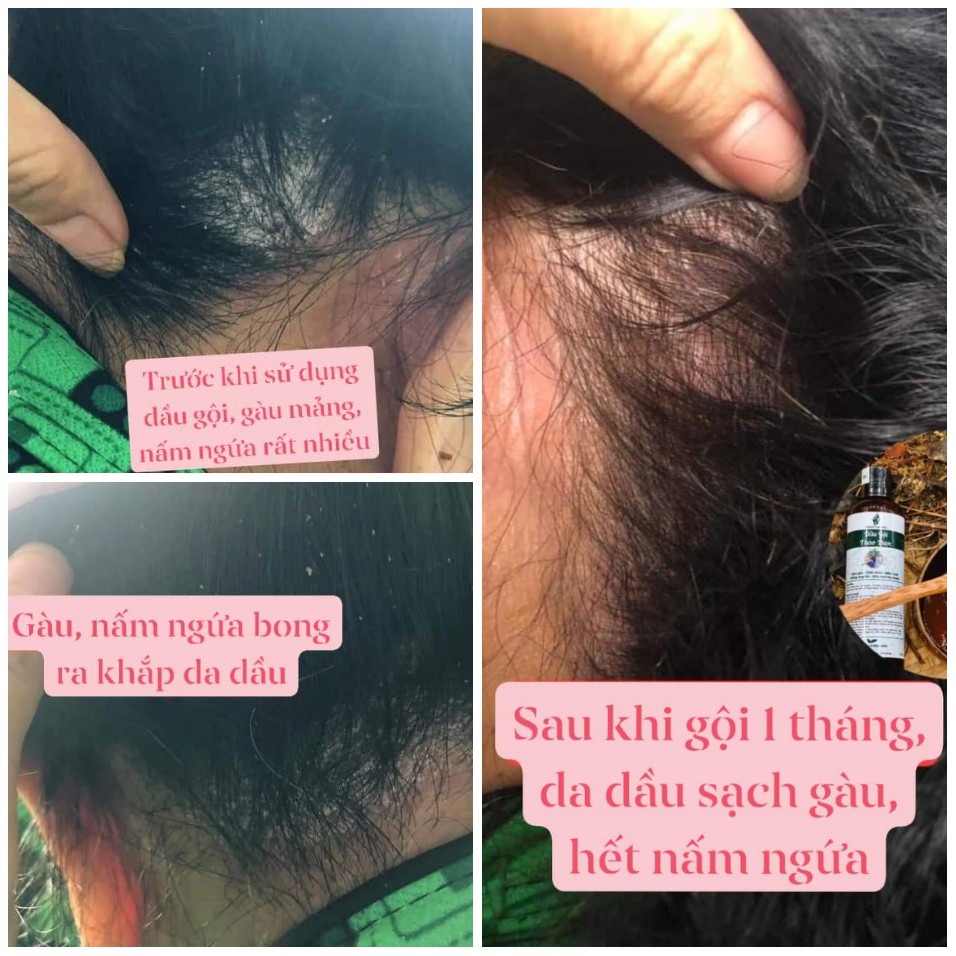 DẦU GỘI THẢO DƯỢC ngăn rụng tóc, sạch gàu ngứa, kích thích mọc tóc, kiềm dầu chống bết | BigBuy360 - bigbuy360.vn