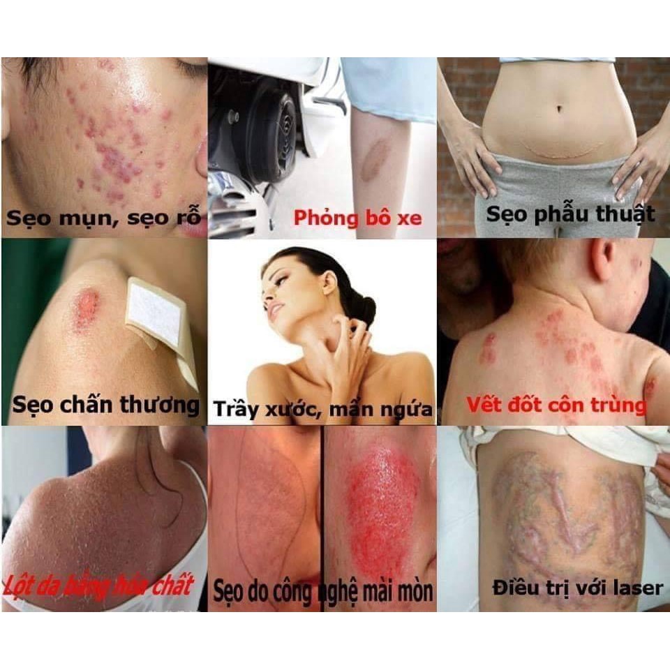 Kem mờ sẹo Scar Esthetique số 1 thế giới