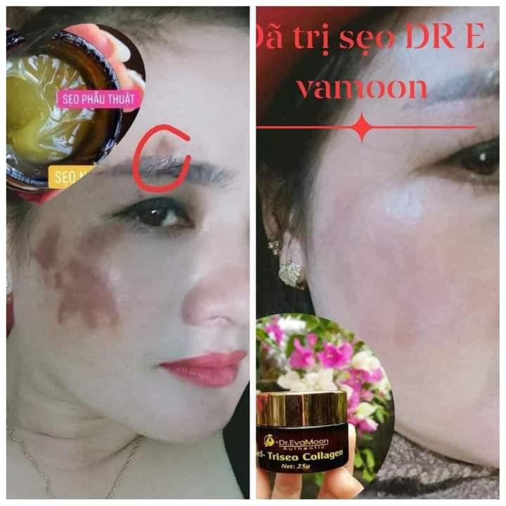 Kem Sẹo, Kem Sẹo Thâm, Rỗ Collagen Tươi Dr.EvaMoon