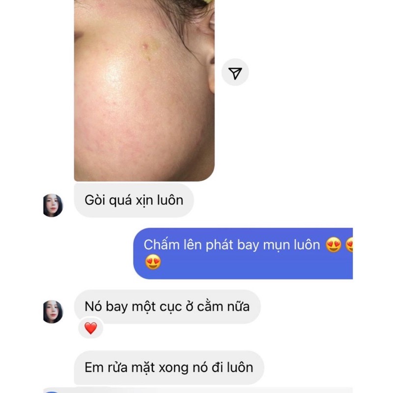 Kem chấm mụn tràm trà HANDMADE | BigBuy360 - bigbuy360.vn