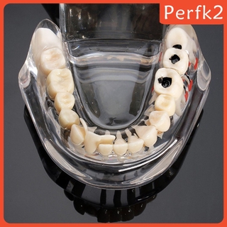 2x Human Mouth Dental Teeth Pathological Model Teaching Study Tools Clear