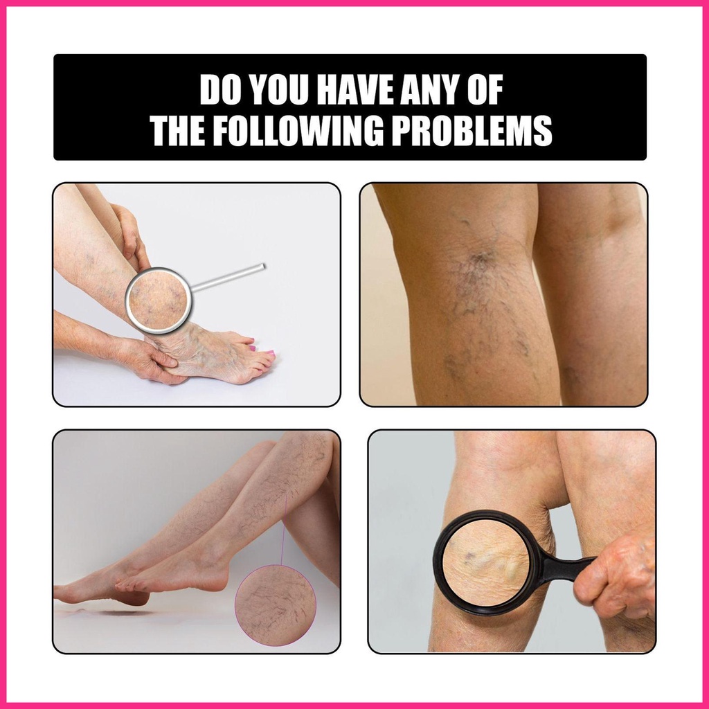 Bộ 12 Miếng Dán Trị Giãn Tĩnh Mạch Cao Cấp Chuyên Dụng