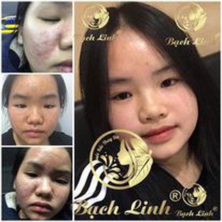 Bạch Linh 02 - Chuyên Mụn