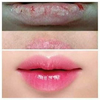 Dưỡng Hồng môi, làm mềm môi (ủ môi)