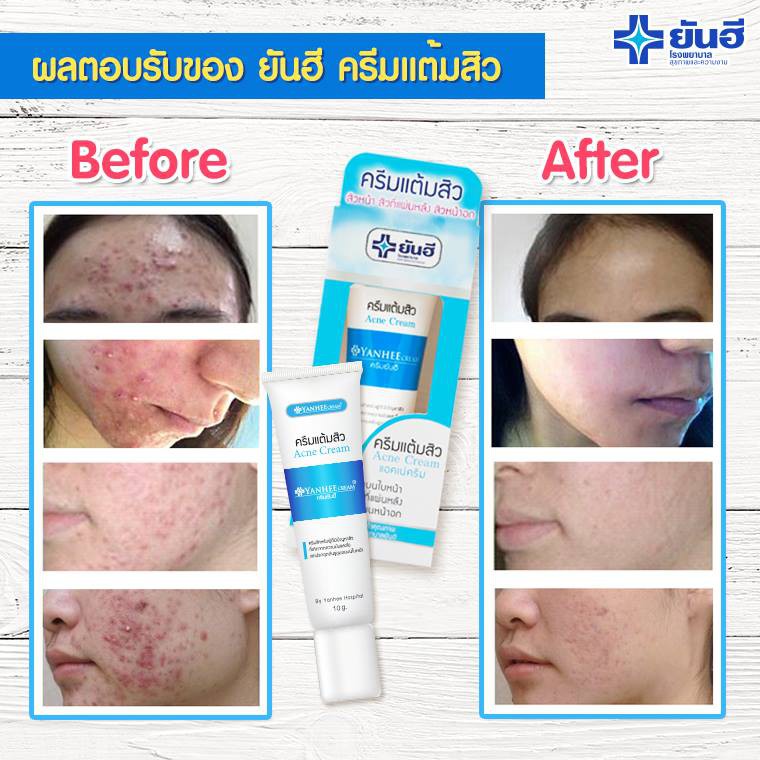 Kem Thoa Mụn Yanhee Acne Cream Thái Lan 10g