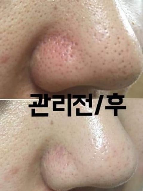 SIÊU Ủ MỤN CỦA MĨ SUPER X LOTION 1LÍT