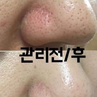 SIÊU Ủ MỤN CỦA MĨ SUPER X LOTION 1LÍT