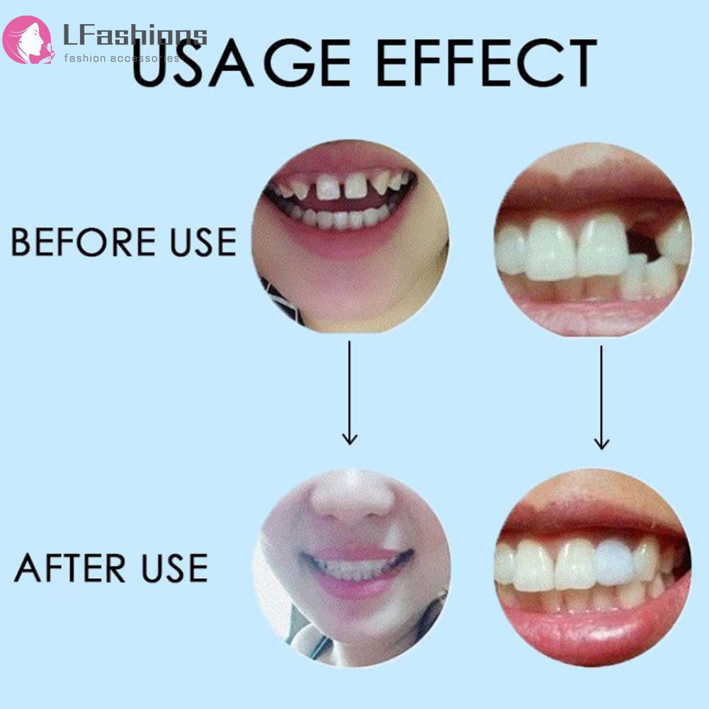 Keo trám khe răng 10/100g