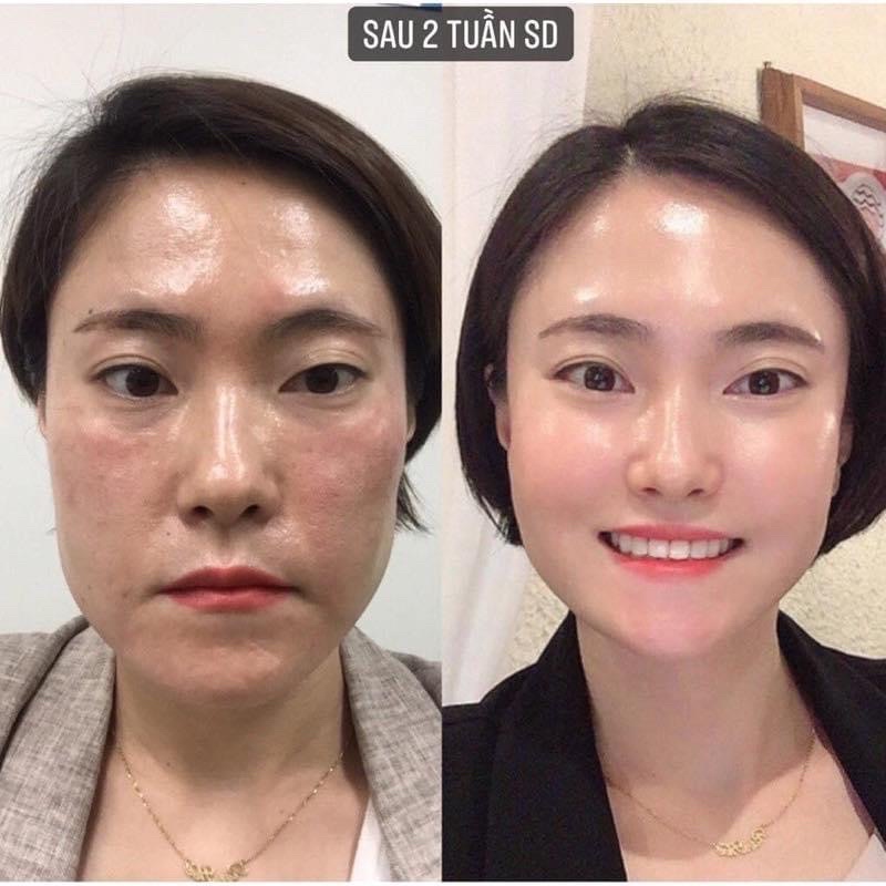 Tinh chất HYALURONIC TRX ekseption - CẢI THIỆN SẮC TỐ DA SAU 10 NGÀY