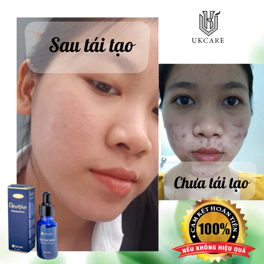 DETOX SKIN – SẠCH MỤN, SẠCH KHUẨN UKCARE | BigBuy360 - bigbuy360.vn