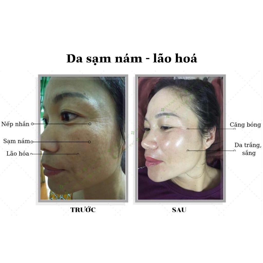 MUA 1 TẶNG 1 - Peel da trẻ hóa Tảo Canxi Doctor One giảm mụn nám, thâm sạm, căng bóng trắng sáng da